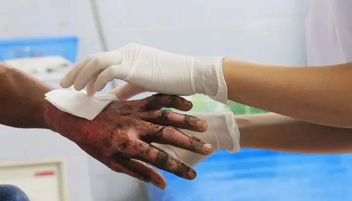 burn-injury-one